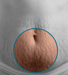 stretch marks