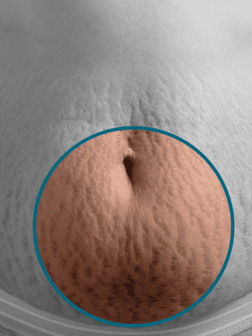 stretch marks