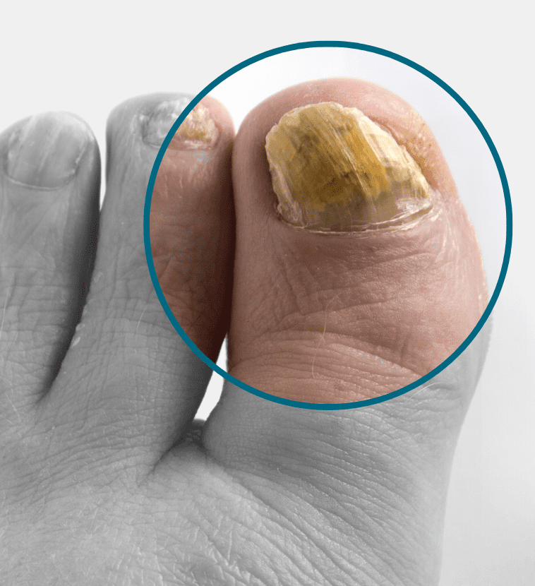 Thickened Toenails - The Foot People