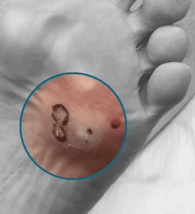 VERRUCAE on foot