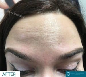 Anti-wrinkle injections botox