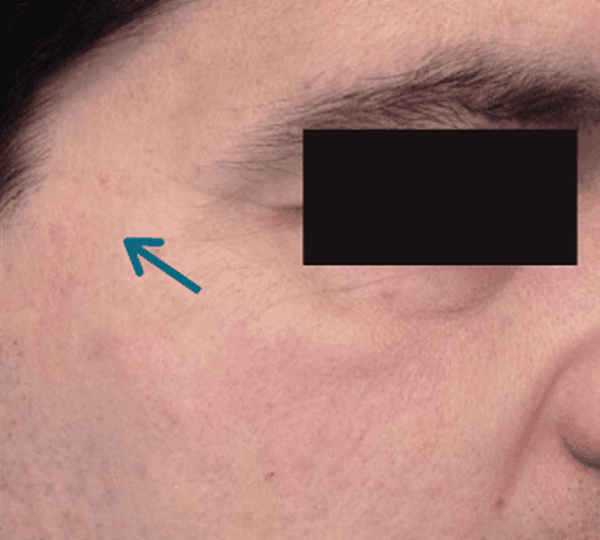 dermal fillers treatment after