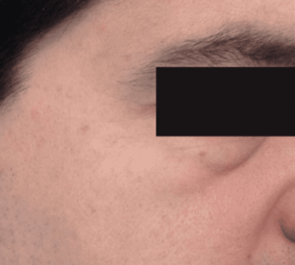 dermal fillers treatment before