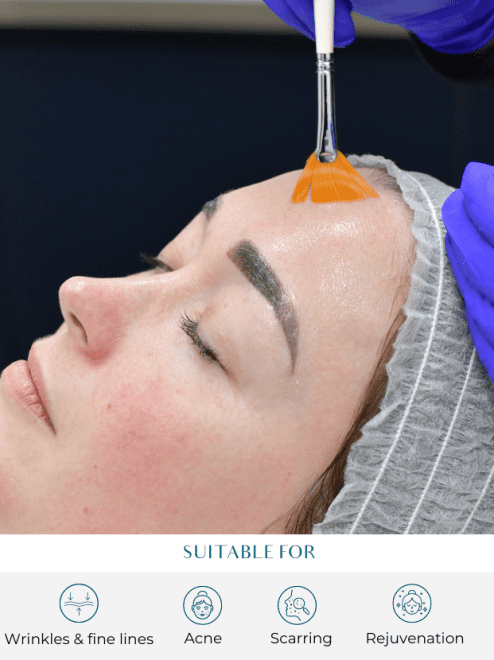 chemical peels