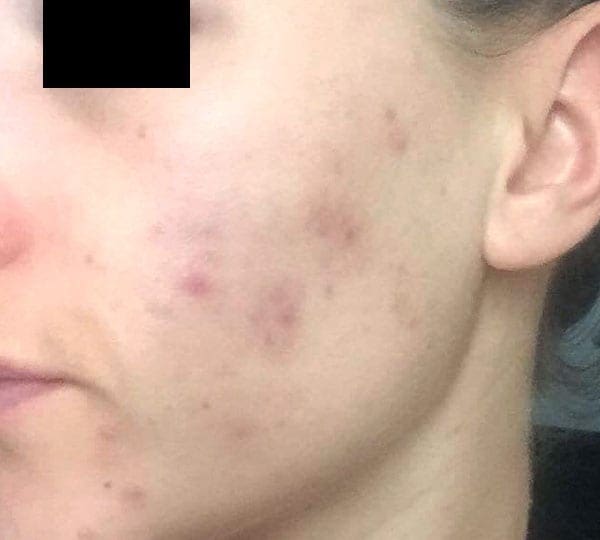 chemical peels after treatment