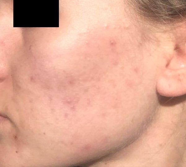 chemical peels before treatment
