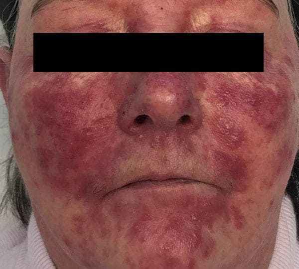 chemical peels before treatment