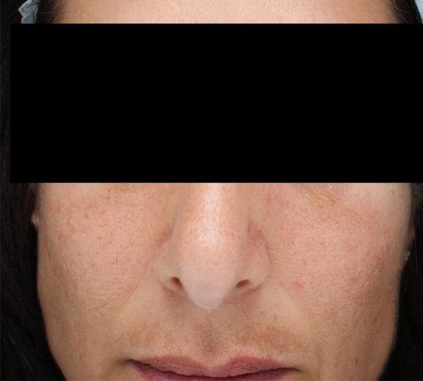 chemical peel before treatment