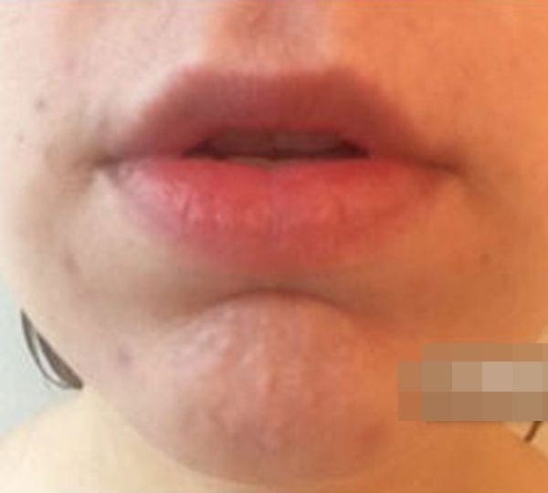 peel after treatment