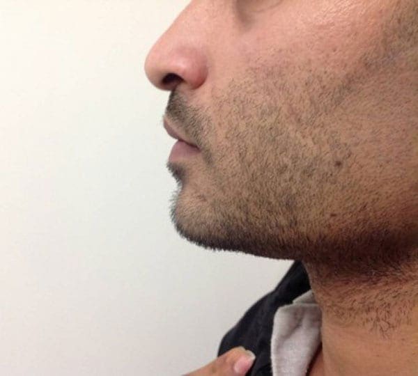 jaw filler after
