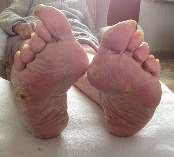 chiropody treatment before