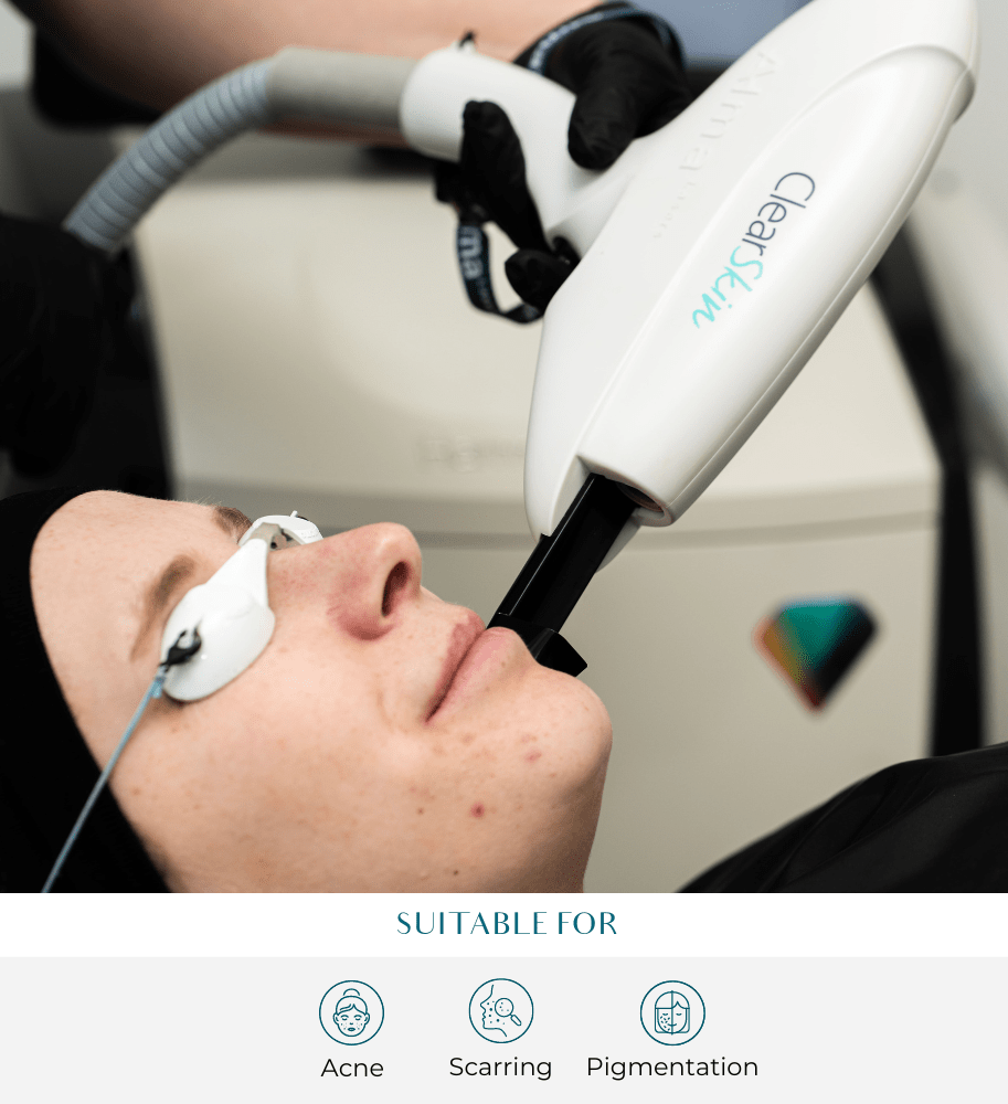 ClearSkin Treatment at Perfect Skin Solutions