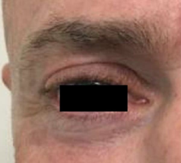 blepharoplasty treatment after