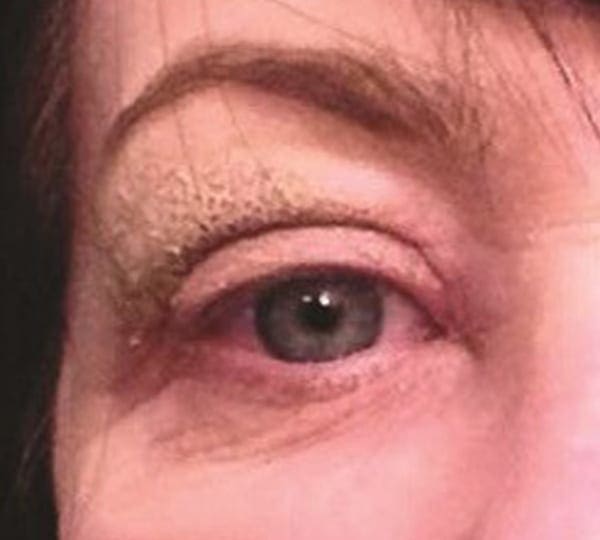 blepharoplasty treatment after