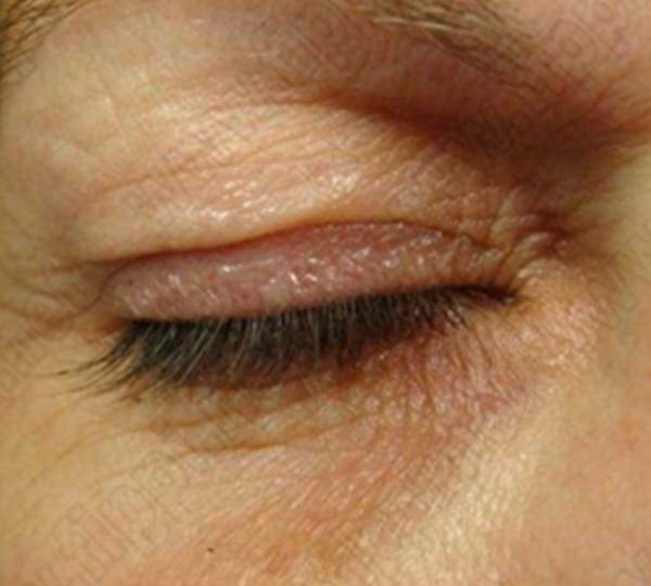 blepharoplasty before