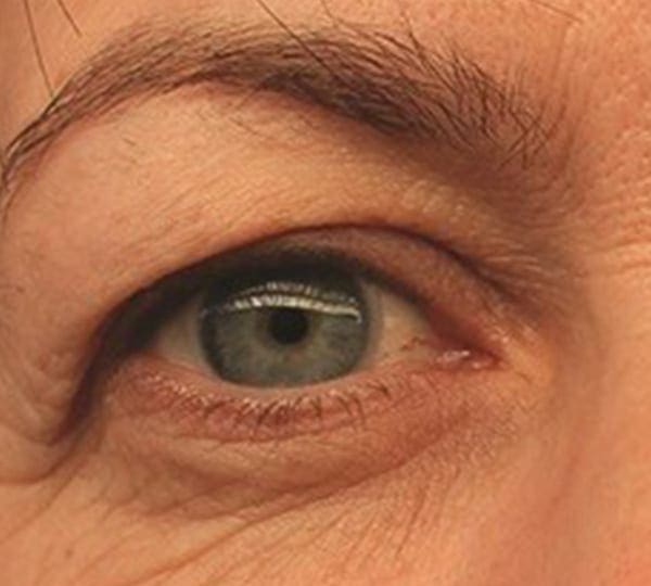 blepharoplasty treatment before