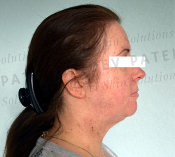 necktite treatment after