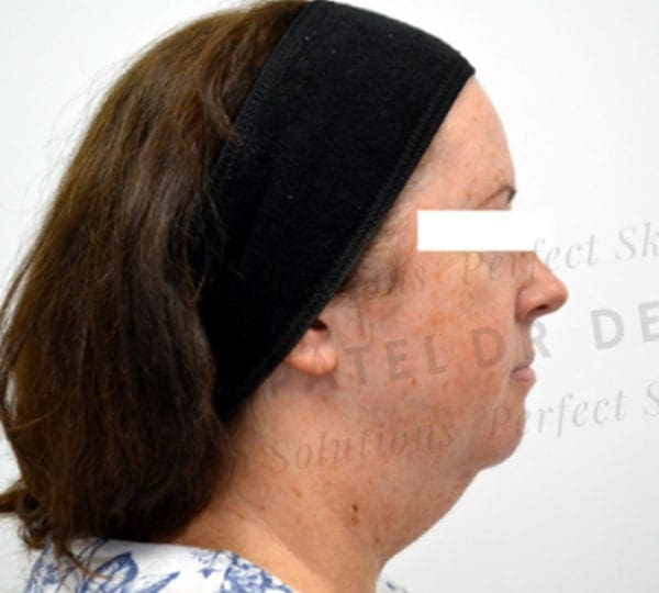 necktite treatment before