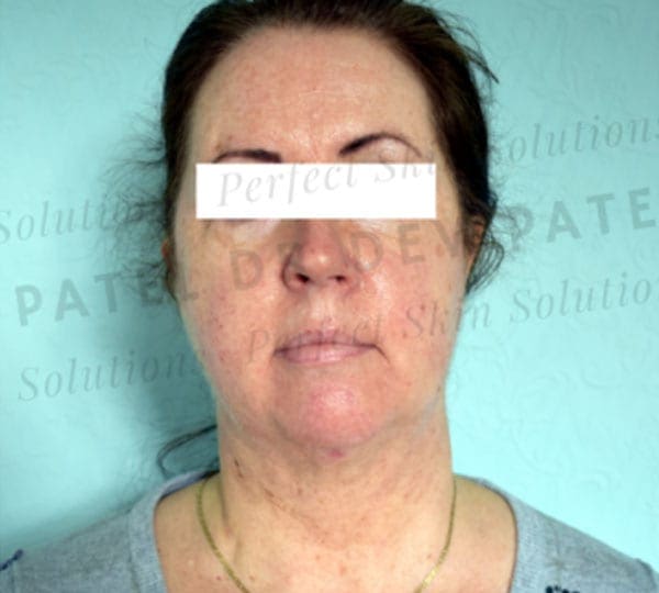 facetite treatment after