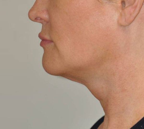 facetite treatment before