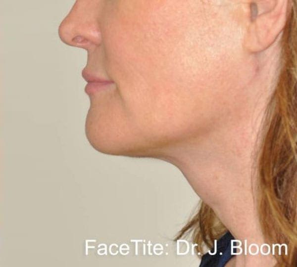 facetite treatment after