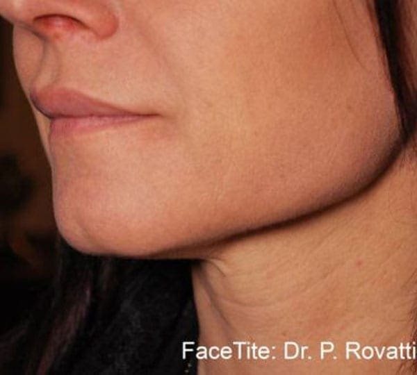 facetite treatment after