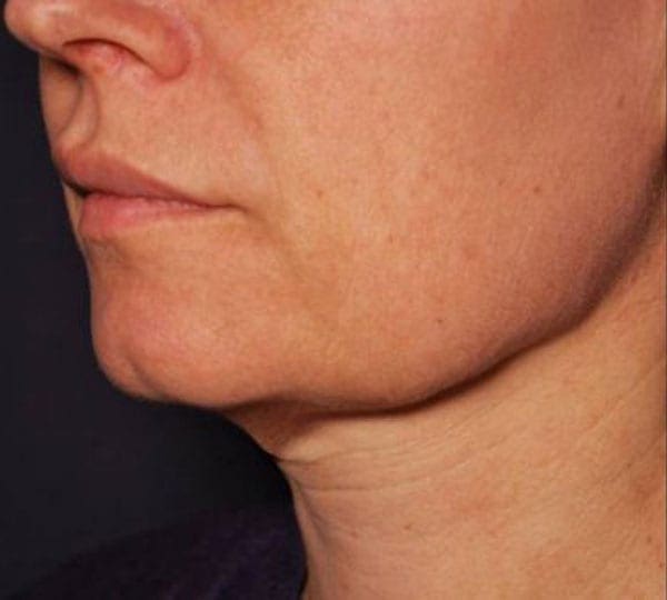 facetite treatment before