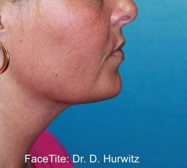 necktite treatment after