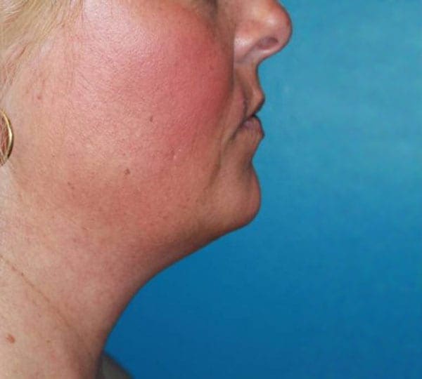 necktite treatment before