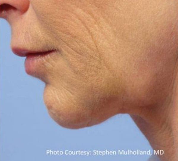 facetite treatment after