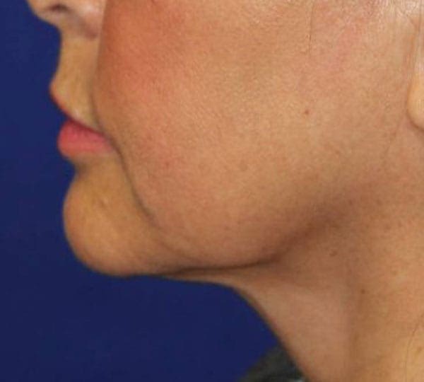 necktite treatment after