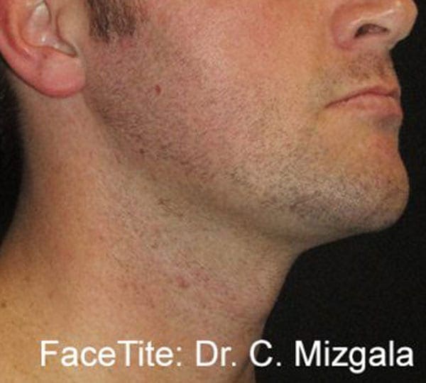 facetite treatment after