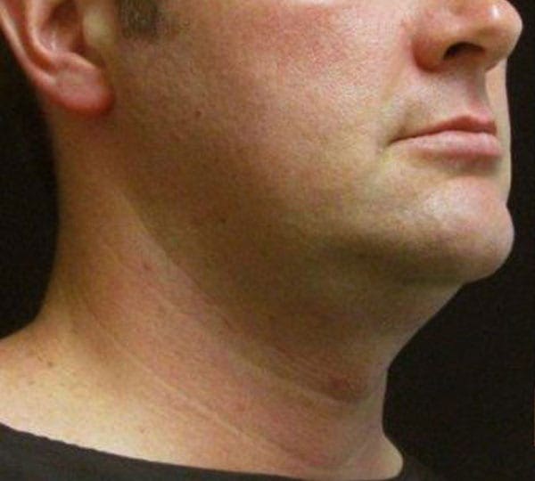 facetite treatment before