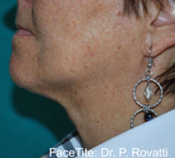 facetite treatment after