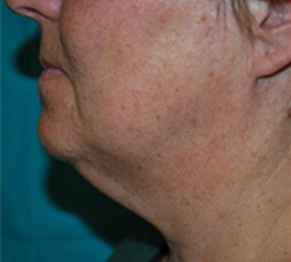 facetite treatment before