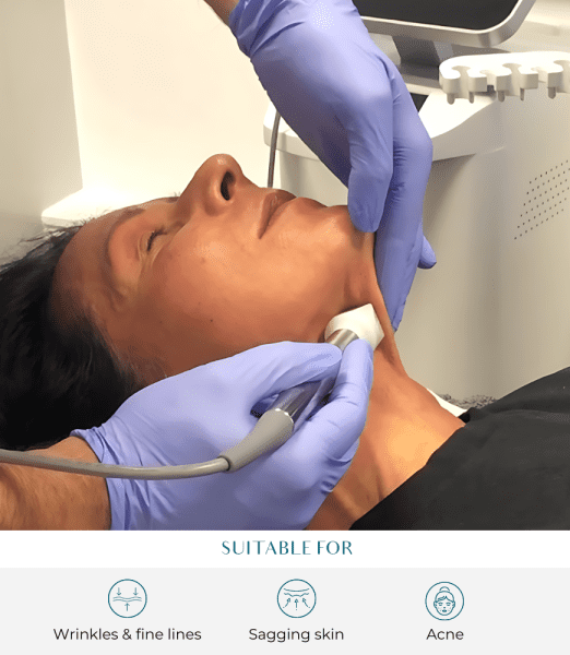 Fractional Resurfacing: Advanced Laser Treatment at Perfect Skin Solutions