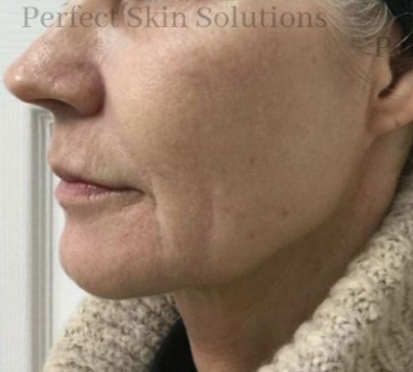 iPixel Skin Resurfacing treatment after