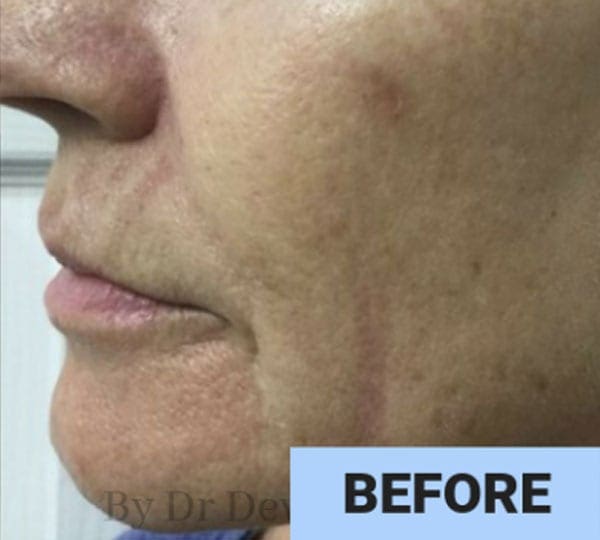 iPixel Skin Resurfacing treatment