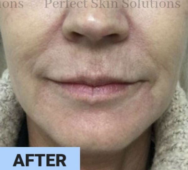 Skin Resurfacing after
