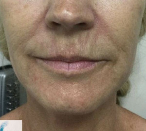 Skin Resurfacing before