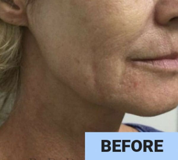 face resurfacing before
