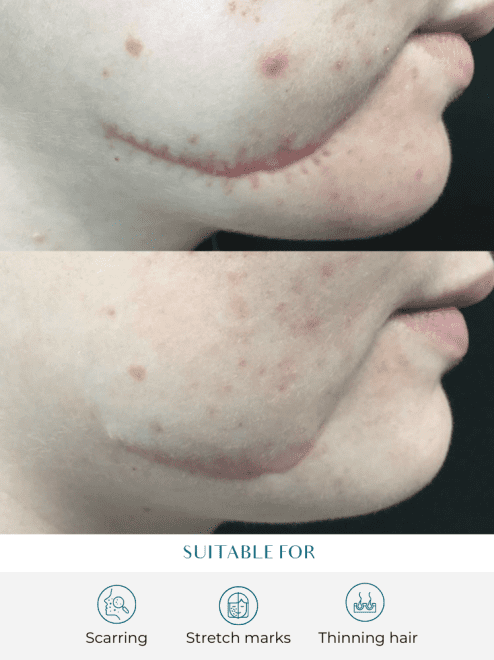 iprf treatment benefits