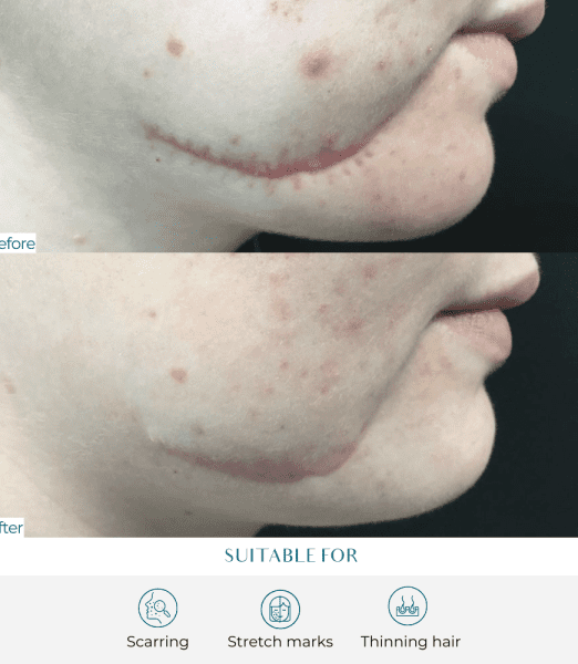 iPRF (Injectable Platelet Rich Fibrin)