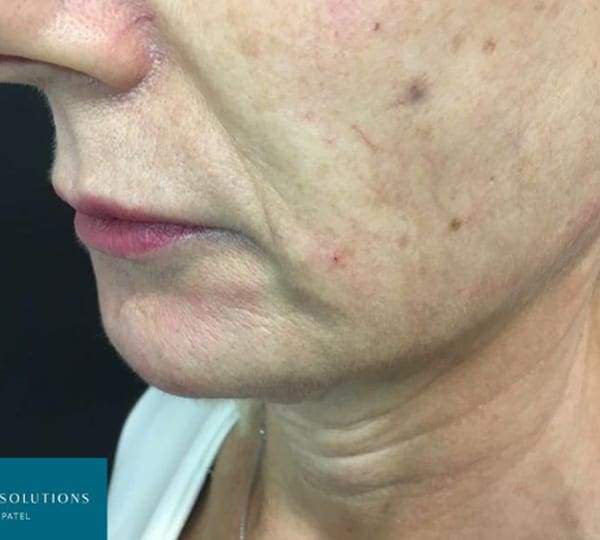 jawline filler after