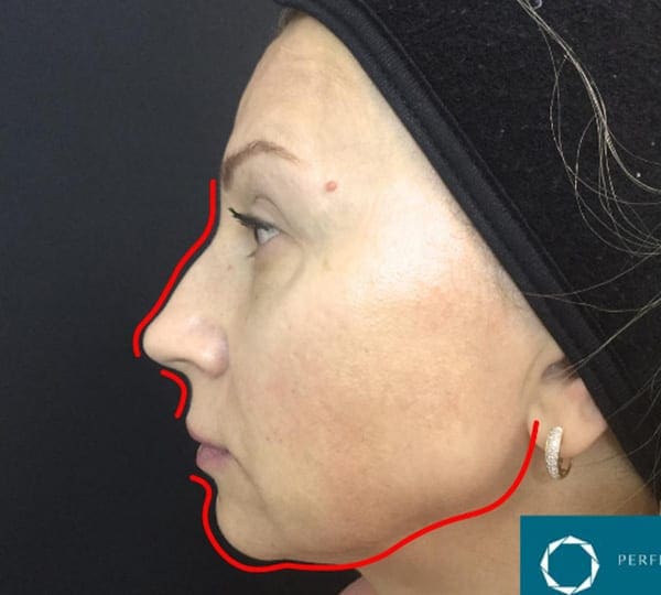jawline filler before