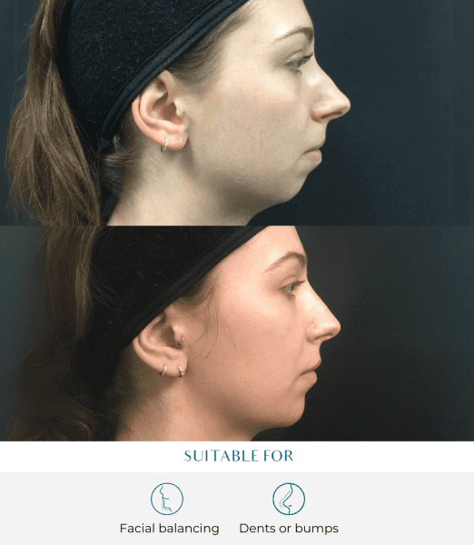 How Long Does Filler Last? Everything You Need to Know