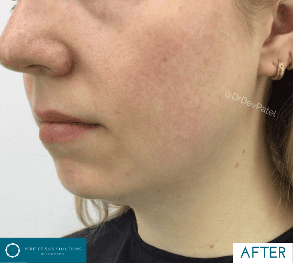 face contouring after