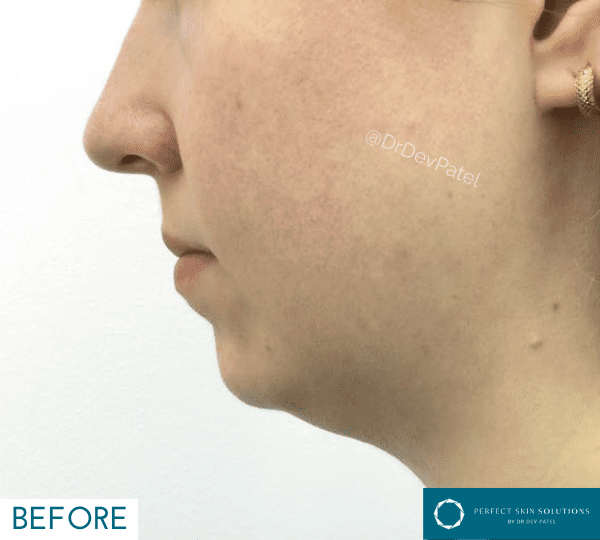 facial contouring before