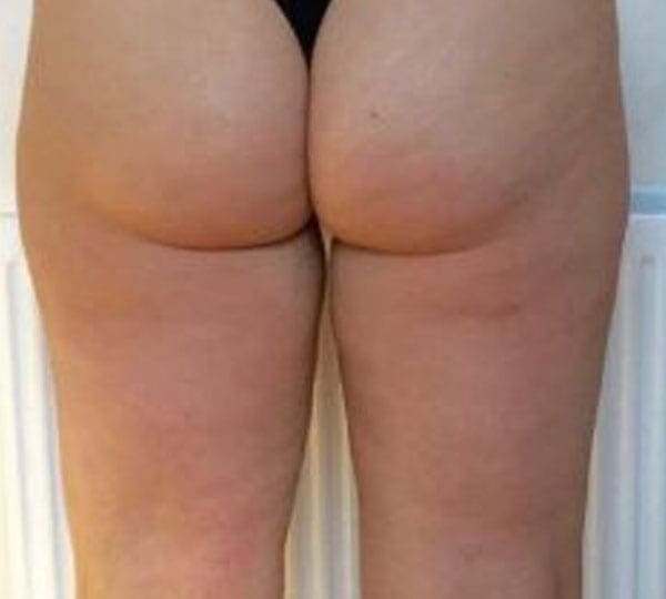 lipofirm pro after