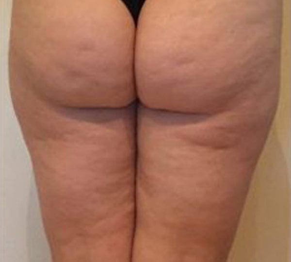 lipofirm before